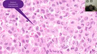 Chondroblastoma [upl. by Castorina]