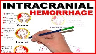 Intracranial Hemorrhage EpiduralSubduralSubarachnoid overview [upl. by Strong549]