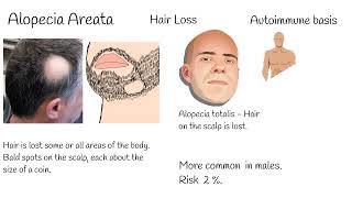 Hair Loss Alopecia AreataTreatment  NEW FDA Approved New drug  Olumiant Baricitinib [upl. by Razatlab844]