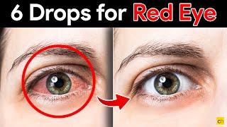 Fast and Effective 6 Eye Drops to Cure Red Eyes  Credihealth [upl. by Agbogla]