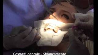 Cosmesi dentale Sbiancamento [upl. by Tommie]