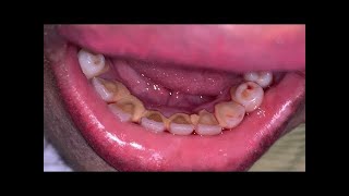 Deep Cleaning With HEAVY Tartar Build Up At The Dentist [upl. by Tung]