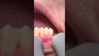 Zirconia crowns satisfying asmr [upl. by Housum]