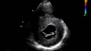 HOCM  CARDIOMYOPATHY HYPERTROPHIC echocardiography [upl. by Joerg]