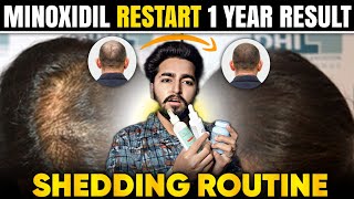 Minoxidil Restart 1 Year Results Shedding and Routine [upl. by Auoy]