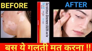 tacroz ointment use in hindi  tacrolimus ointment [upl. by Narod]