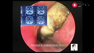 Endoscopic removal of nasal foreign body almost into a fossil [upl. by Myca379]