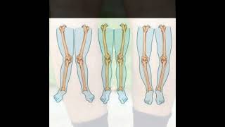 Bow Legged Treatment  Symptoms and Causes  Diagnosis  Prevention health [upl. by Attelocin]