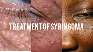 Treatment of syringoma [upl. by Wardlaw]