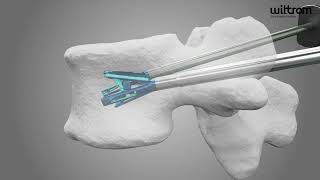 TripodFix Vertebral Augmentation System  Wiltrom [upl. by Adyam181]