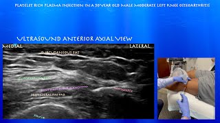 Ultrasound of Knee Joint Platelet Rich Plasma Injection by probeultrasoundcom [upl. by Towroy]