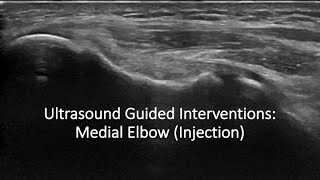 Ulrasound Guided Interventions Medial Elbow Injection ultrasound [upl. by Fougere130]