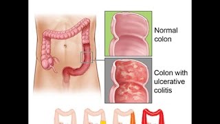 Ulcerative Colitis [upl. by Midan42]