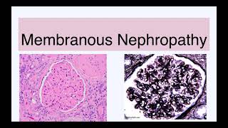 Membranous nephropathy [upl. by Tjaden442]