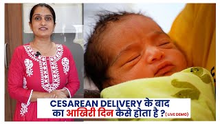 Day of Discharge for Caesarean  Day 2 for Twin Pregnancy  Live Demo  Dr Asha Gavade [upl. by Uranie]