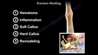 Fracture Healing  Everything You Need To Know  Dr Nabil Ebraheim [upl. by Emyle]