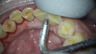 Warning How Teeth Tar and Plaque Ruin Your Smile dentist teethcleaning teeth dental cavity [upl. by Arrimat]