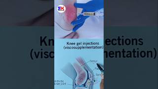 Knee Gel Injections Viscosupplementation shorts medicineknowledgehindi [upl. by Genvieve971]