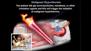 Malignant Hyperthermia  Everything You Need To Know  Dr Nabil Ebraheim [upl. by Nahtnoj]