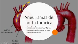 Aneurisma de aorta torácica [upl. by Adohr]