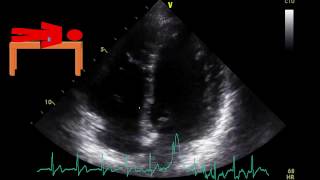 Echocardiogram Orthostasis Highly Reactive Heart Rate [upl. by Treulich]