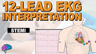 Recognize ST Elevation Myocardial Infarction STEMI on 12lead EKG [upl. by Adnylem652]