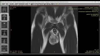 Testicular tumor [upl. by Romo541]