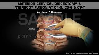 Anterior Cervical Discectomy amp Interbody Fusion at C45 C56 amp C67 [upl. by Mcclenon]