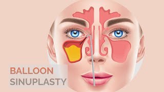 Balloon Sinuplasty Surgery Procedure In Animation [upl. by Hcurab]