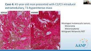 AANP Teaching Rounds  October 23 2024  Hereditary Tumor Syndromes Associated with CNSPNS Tumors [upl. by Shiff]