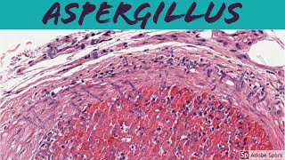 Aspergillus Cutaneous Aspergillosis  Angioinvasive Fungus 5Minute Pathology Pearls [upl. by Corkhill]