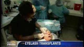 Eyelash Transplant on CNN Headline News [upl. by Yendic]