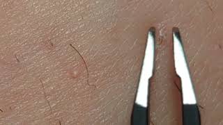 Take it tweezy with fine and tiny ingrown hair smooth pulls [upl. by Bennet]