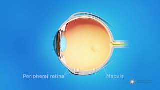 What is retinopathy of prematurity ROP [upl. by Mervin169]