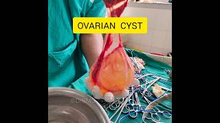 Ovarian Cyst ovariancancer ovaries cyst cancer gynaecology obstetricsandgynecology shorts [upl. by Iddet659]