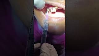 Local Infiltration anesthesia LIA  Upper Premolar  DrteethSohel semapur [upl. by Acirdna]