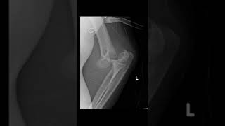 Supracondylar region fracture xray anatomy [upl. by Artekal]