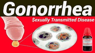 Gonorrhea homeopathic treatment [upl. by Griffiths]