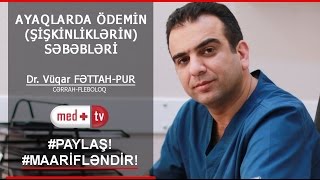 AYAQLARA QULLUQ  ÖDEMİN SEBEBLERİ  ŞİŞKİNLİKLƏR Dr Vuqar FETTAHPUR CərrahFleboloq MEDPLUS [upl. by Damian]