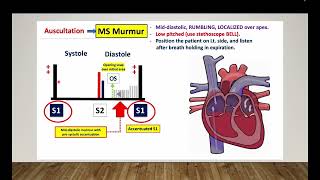 Mitral stenosis  Omar Layth  Cardiology made easy [upl. by Yalhsa]