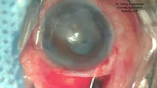 Small Incision Cataract surgery  IOL with Optical Iridectomy ONE EYED AC Reformation done Twice [upl. by Lahpos]