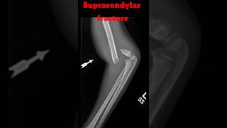 Supracondylar Fracture shorts fracture supracondylarfracture elbowxray radiology [upl. by Mou589]