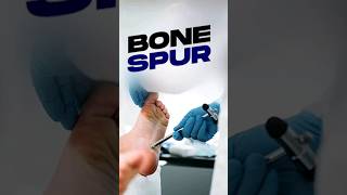 How Arthritis Leads to Cartilage Wear Bone Spurs and Joint Calcification [upl. by Novla208]