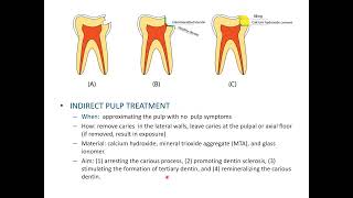 Indirect pulp capping management of deep carious lesion CaOH2 liner protection [upl. by Sandi]