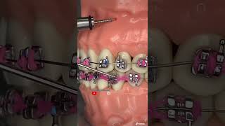 ¡🔥Guía para instalar microimplantes dentales ANCLAJE ESQUELÉTICO🔥 [upl. by Waldo]