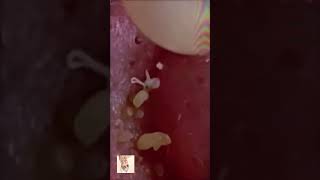 Blackheads Removal  Acne Treatment and Very Satisfying Satisfying Pimple pop blackheads [upl. by Alviani]