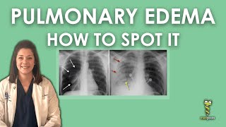 Causes of Fluid Buildup In Your Lungs Pulmonary Edema Causes amp Symptoms [upl. by Wardieu305]