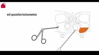 Nasennebenhöhlen OP  FESS  chronische Sinusitis [upl. by Aleafar]