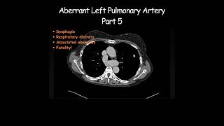 Aberrant Left Pulmonary Artery Part 5 radiology radiologist anatomy [upl. by Natlus]