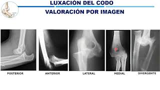 Luxación del codo [upl. by Icak]